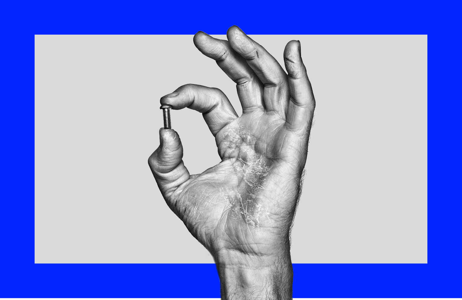 Black and white photograph of a hand with moderate to severe hand eczema making an 'okay' gesture while holding a mushroom head screw between forefinger and thumb.