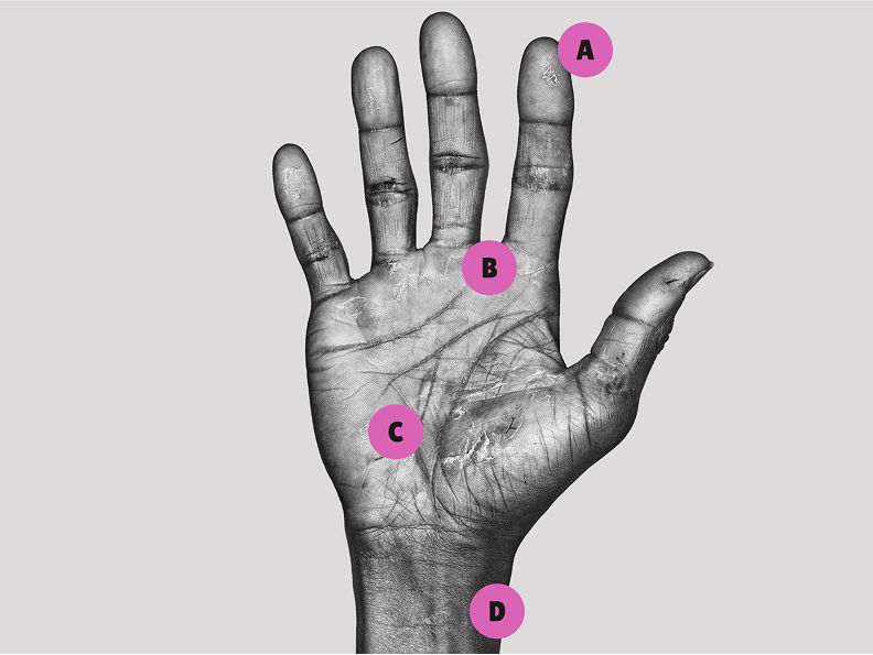 Black and white photograph of a hand with moderate to severe hand eczema with the following labels: A = on a fingertip, B = in the space between two fingers, C = on the palm, B = on the wrist.