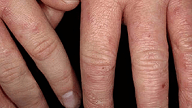 A photograph of a real patients' hand showing signs of edema.