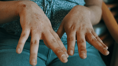Photograph of Emma, real patient with Chronic Hand Eczema, showing her hands.