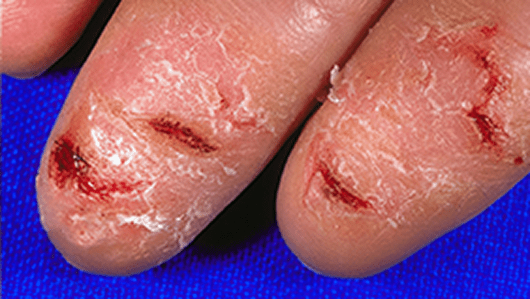 A photograph of a real patients' hand with fissures on the fingertips.