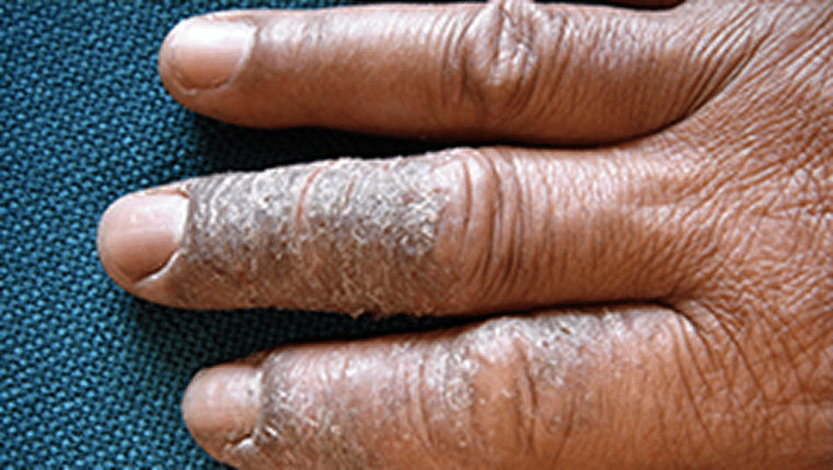 A photograph of a real patients' hand showing signs of hyperkeratosis.