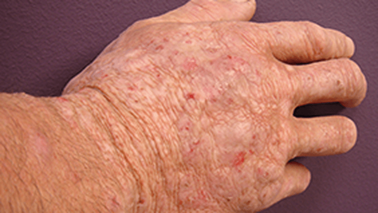 A photograph of a real patients' hand showing signs of lichenification.