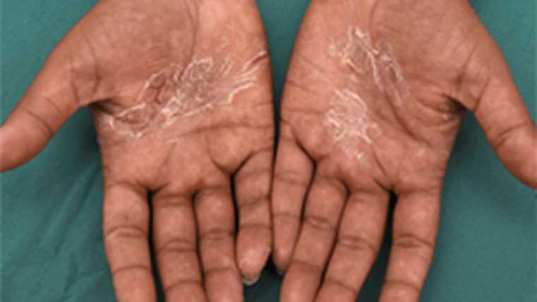 A photograph of a real patients' hand showing signs of scaling.
