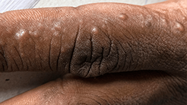 A photograph of a real patients' hand showing signs of vesicles.