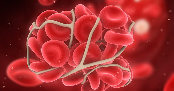 Illustration eines Blutgerinnsels