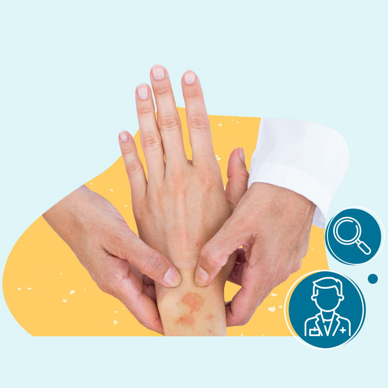 Ψωρίαση και δερματολόγος