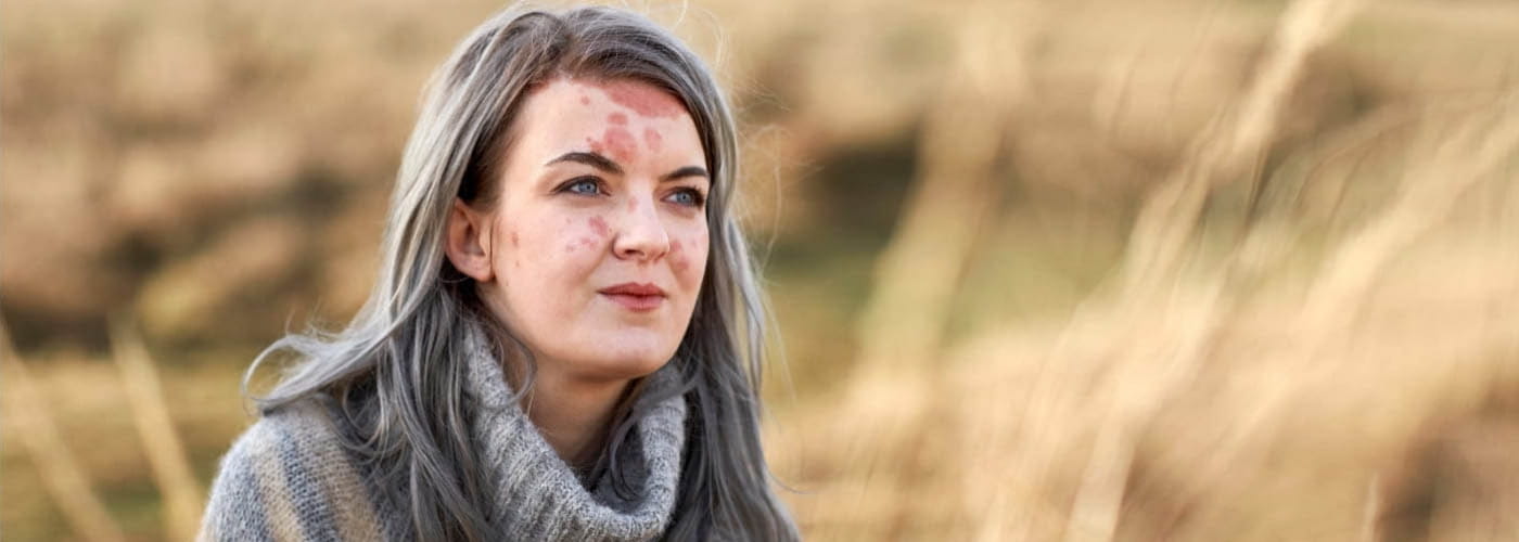 Ψωρίαση στο σώμα