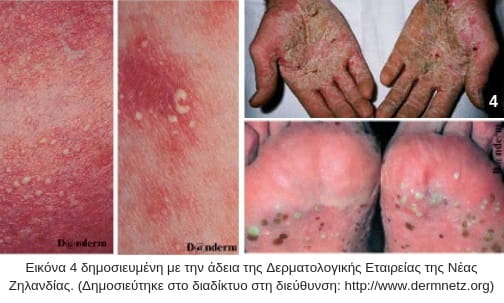 φλυκταινώδης ψωρίαση