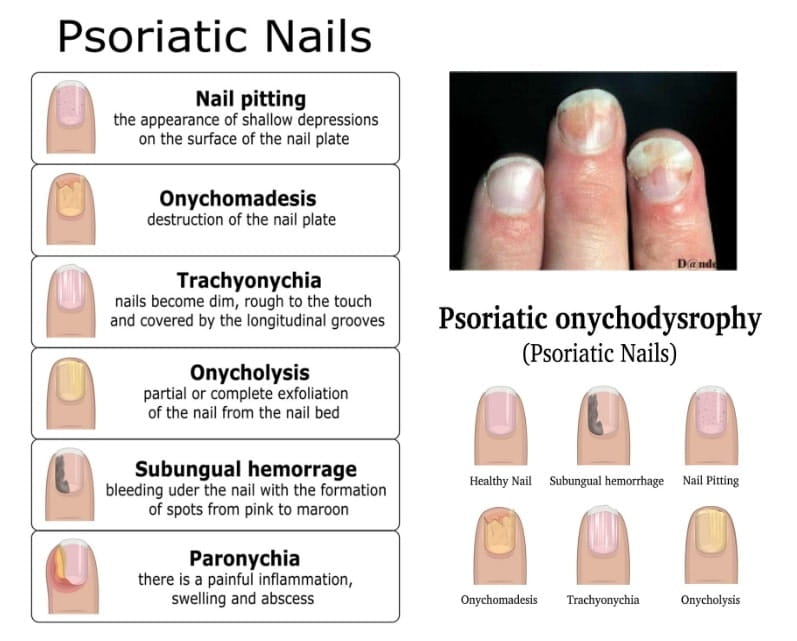 ψωρίαση στα νύχια