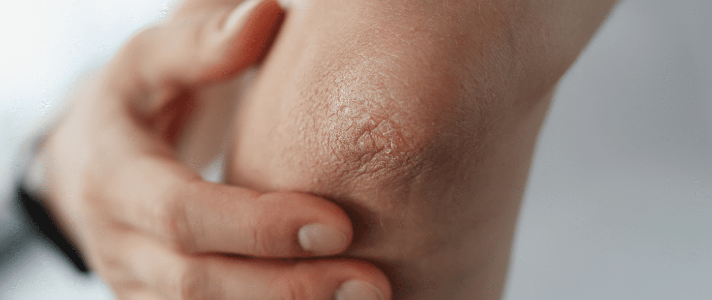 Ψωρίαση κατά πλάκας