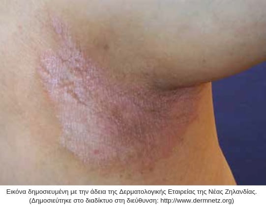 ανάστροφη ψωρίαση