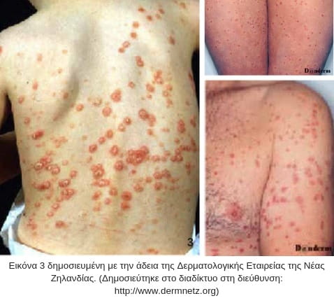 σταγονοειδής ψωρίαση