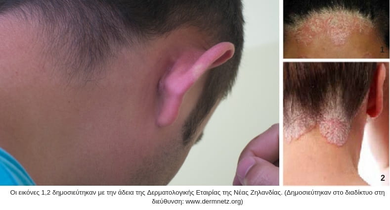 ήπια ψωρίαση κατά πλάκας πίσω από το αυτί και το κεφάλι