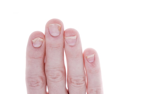 Psoriasis nails