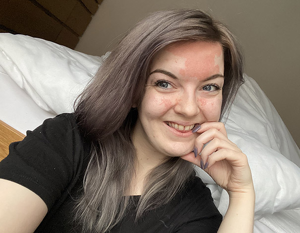 Woman hair psoriasis Jude