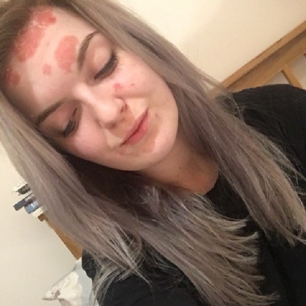 Jude facial psoriasis