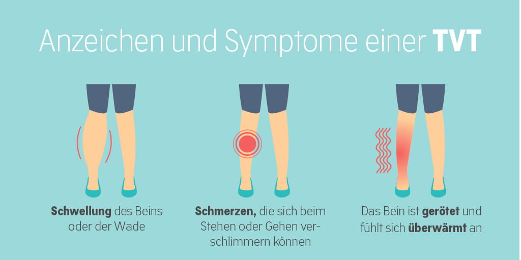 Illustrationen zu Anzeichen einer tiefen Beinvenenthrombose. 