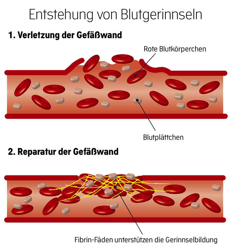 Illustration eines sich entwickelnden Blutgerinnsels bis zur Thrombose