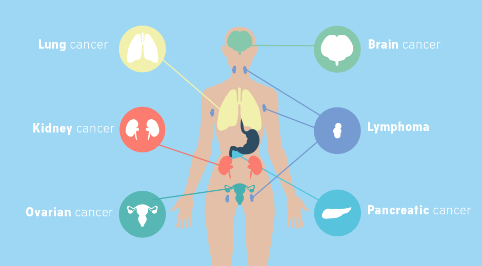 Types of cancer