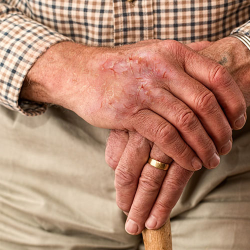 Dry scaly hands of chronic hand eczema