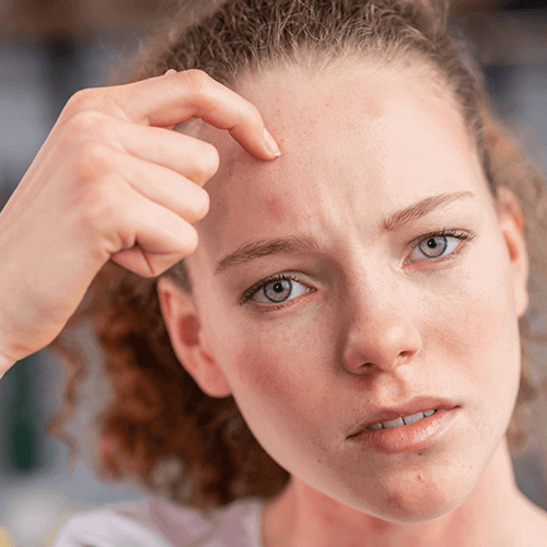 Forehead seborrheic dermatitis