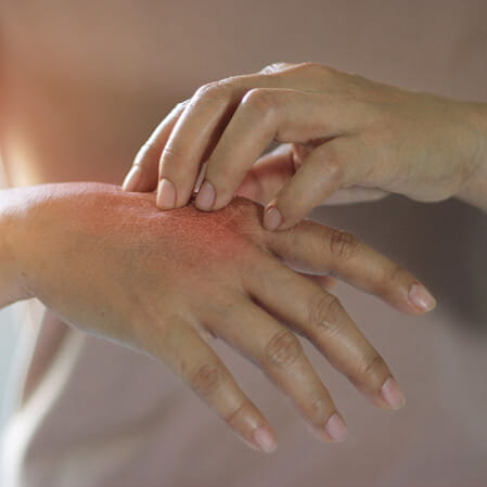 Scratching hand eczema