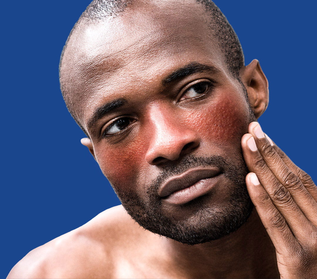 Man with rosacea