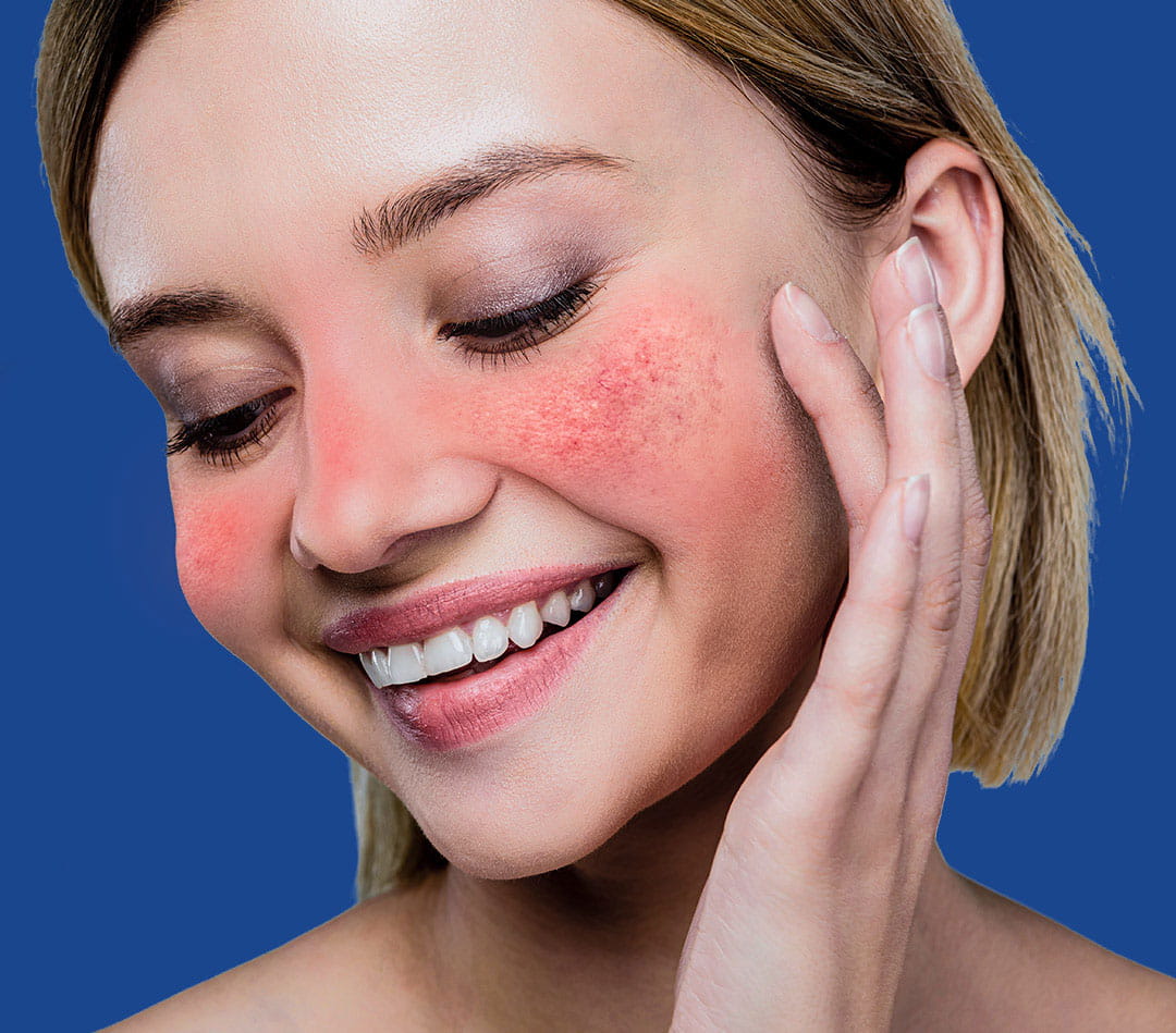 Young woman with rosacea