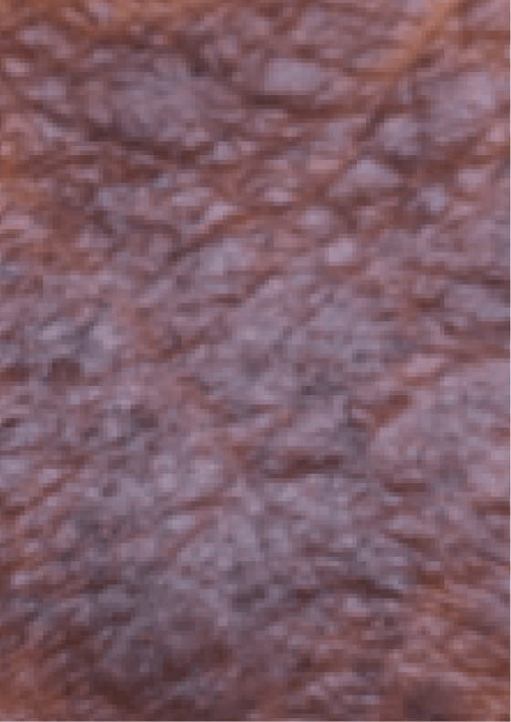 Darkening of the skin due to moderate-to-severe eczema.