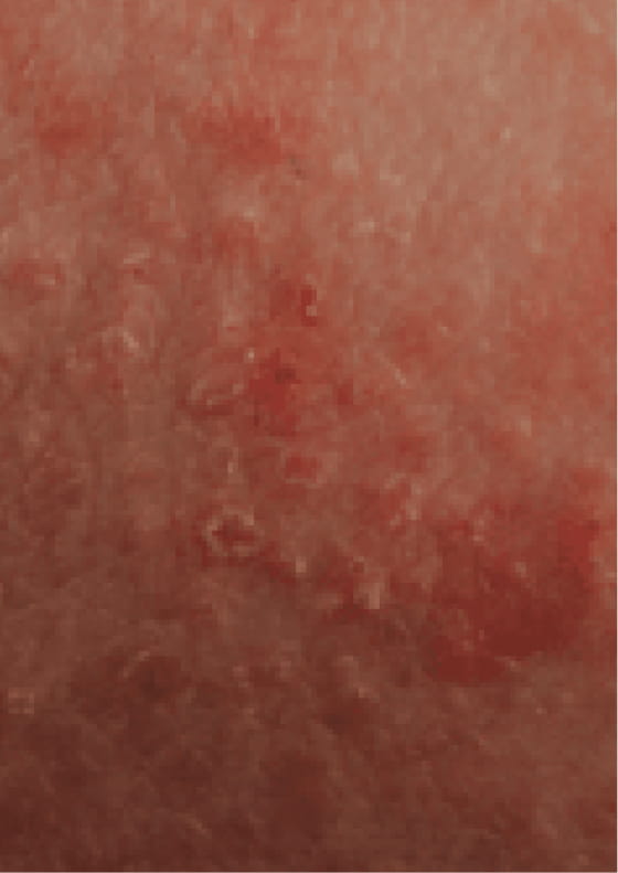 Dry or scaly skin due to moderate-to-severe eczema.