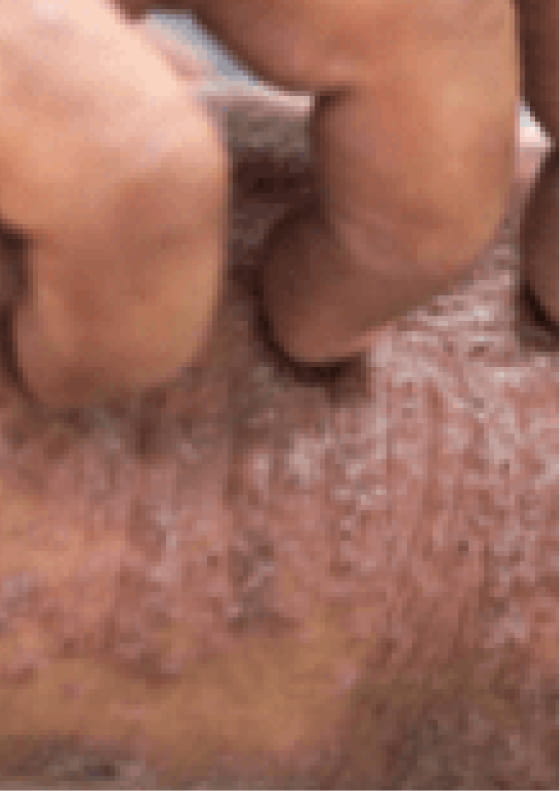 Itching due to moderate-to-severe eczema.