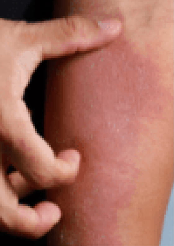 Reddening of the skin due to moderate-to-severe eczema.