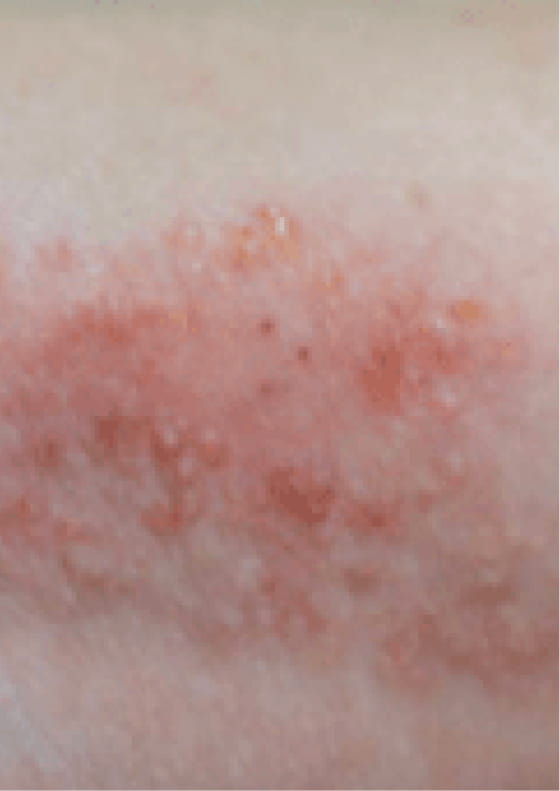 Small raised bumps on skin due to moderate-to-severe eczema.