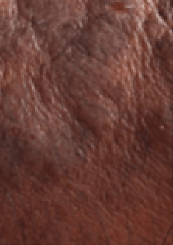 Thickening of skin due to moderate-to-severe eczema.