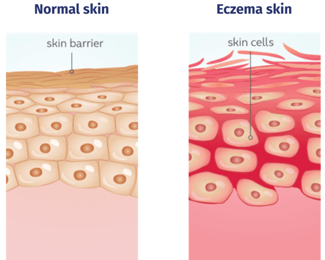 Two images comparing normal skin and skin inflamed with atopic dermatitis (eczema)