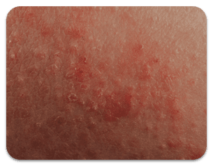 dry/scaly skin impacted by atopic dermatitis (eczema)