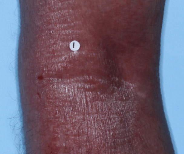 Comparison of inflamed skin on arms with atopic dermatitis (eczema) before and after Adbry® treatment.