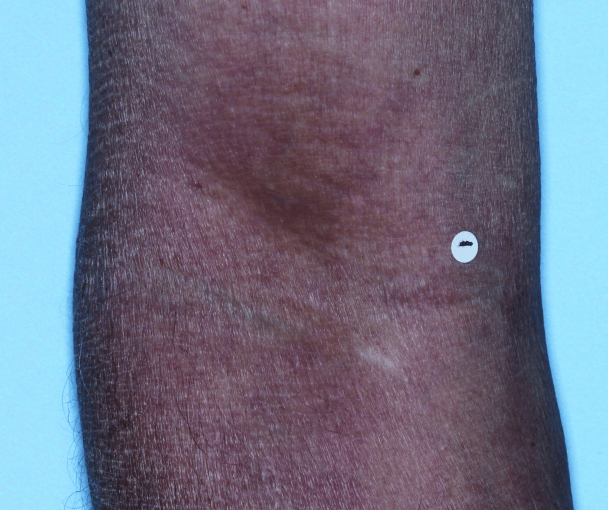 Comparison of inflamed skin on arms with atopic dermatitis (eczema) before and after Adbry® treatment.