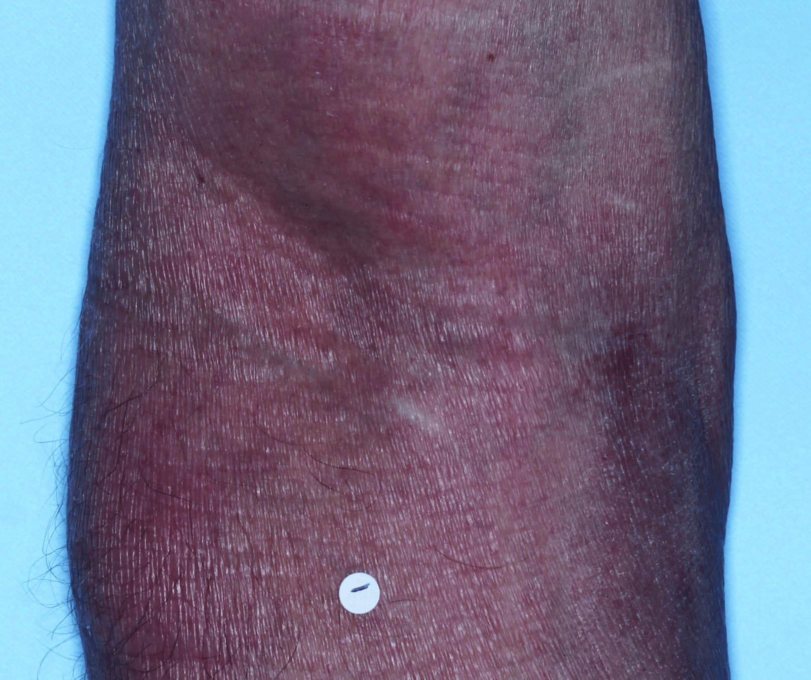 Comparison of inflamed skin on arms with atopic dermatitis (eczema) before and after Adbry® treatment.