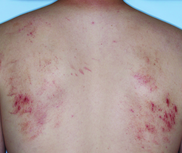 Comparison of inflamed skin on a back with atopic dermatitis (eczema) before and after Adbry® treatment.