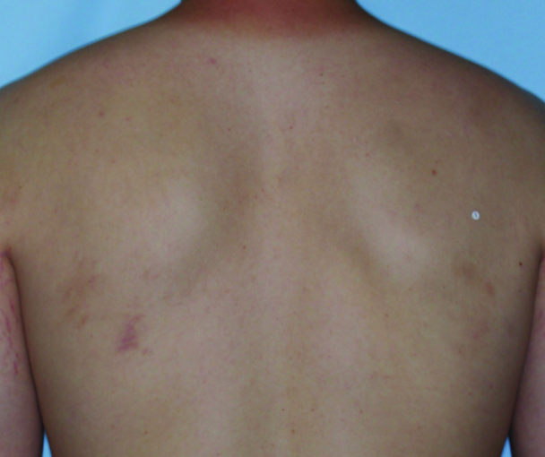 Comparison of inflamed skin on a back with atopic dermatitis (eczema) before and after Adbry® treatment.