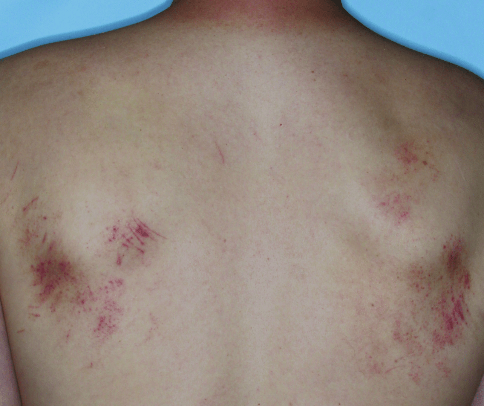 Comparison of inflamed skin on a back with atopic dermatitis (eczema) before and after Adbry® treatment.