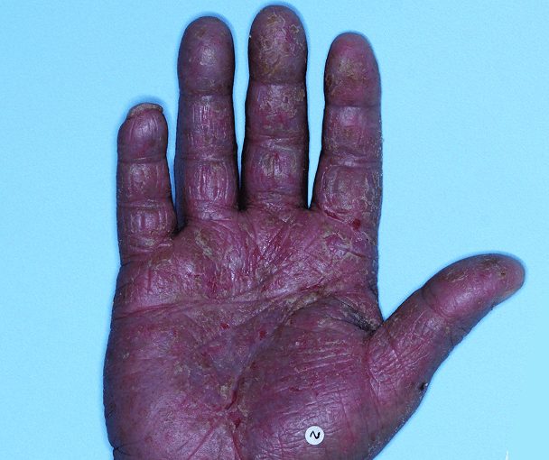 Comparison of inflamed skin on hands with atopic dermatitis (eczema) before and after Adbry® treatment.