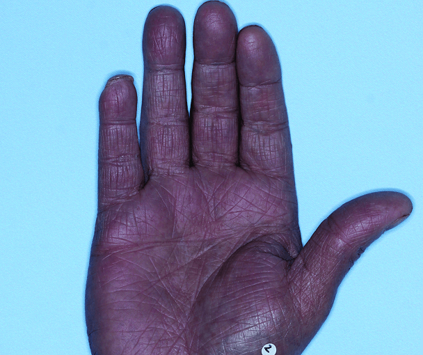 Comparison of inflamed skin on hands with atopic dermatitis (eczema) before and after Adbry® treatment.