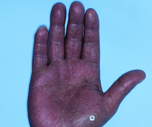 Comparison of inflamed skin on hands with atopic dermatitis (eczema) before and after Adbry® treatment.
