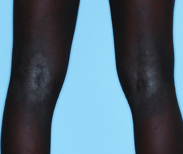 Comparison of inflamed skin on legs with atopic dermatitis (eczema) before and after Adbry® treatment.