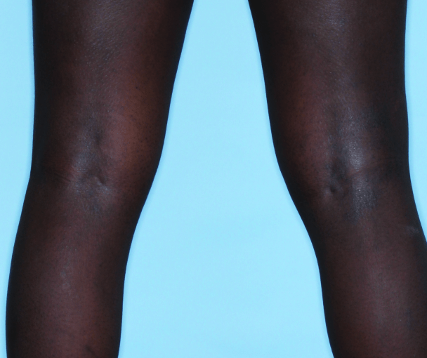 Comparison of inflamed skin on legs with atopic dermatitis (eczema) before and after Adbry® treatment.