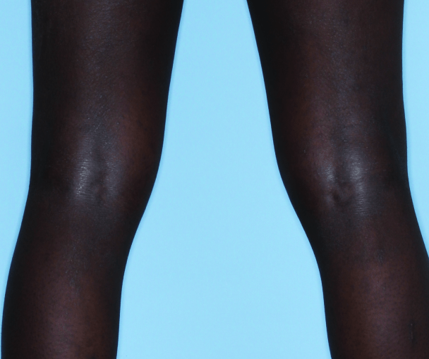 Comparison of inflamed skin on legs with atopic dermatitis (eczema) before and after Adbry® treatment.