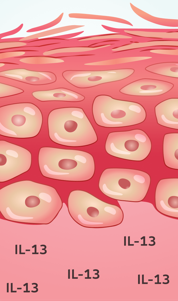 Eczema skin with damage and increased IL-13.